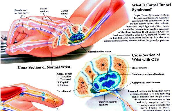 Carpal Tunnle Syndrom