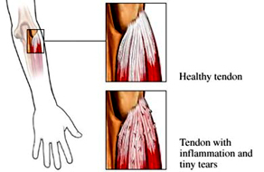 Elbow Injury Demo