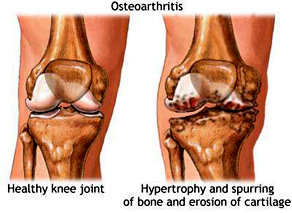 Health Joint Cartilage 
