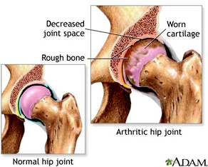 Hip Joint Arthritis