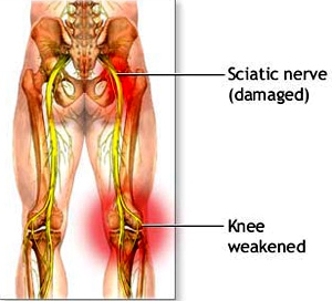 Sciatica Nerve 