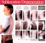 Subluxation