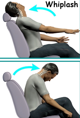 Whiplash Injury and Car Accident